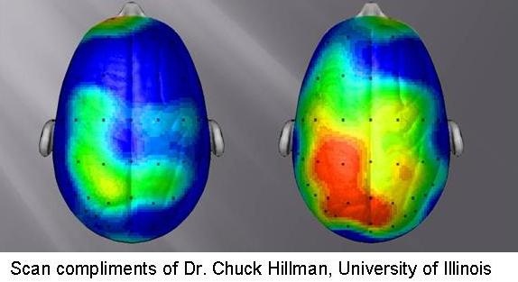 brain scan